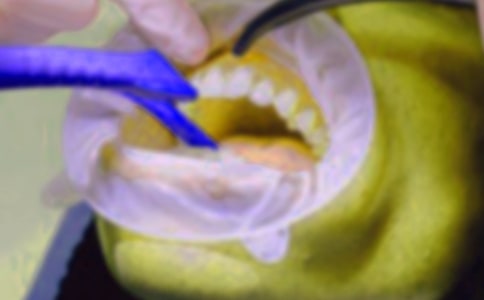 (熱門)拔牙的作文15篇